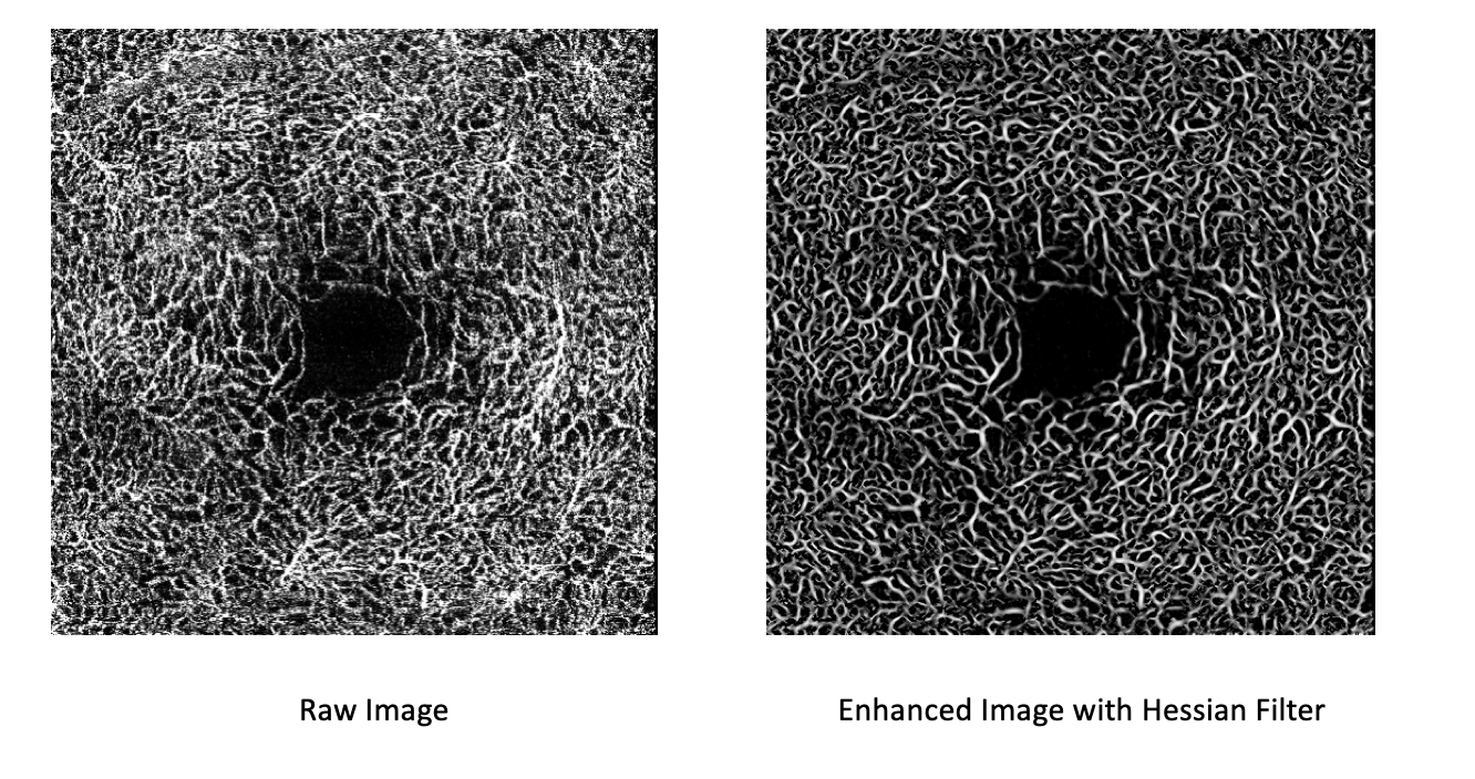 Hessian filter applied to FAZ data