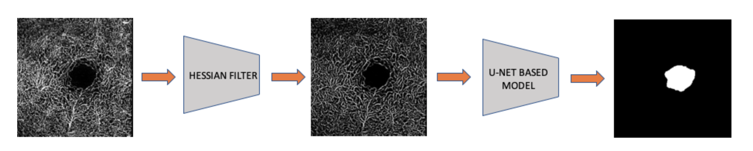 Proposed pipeline: raw OCTA scan → Hessian Filter → enhanced image → U-Net → FAZ mask