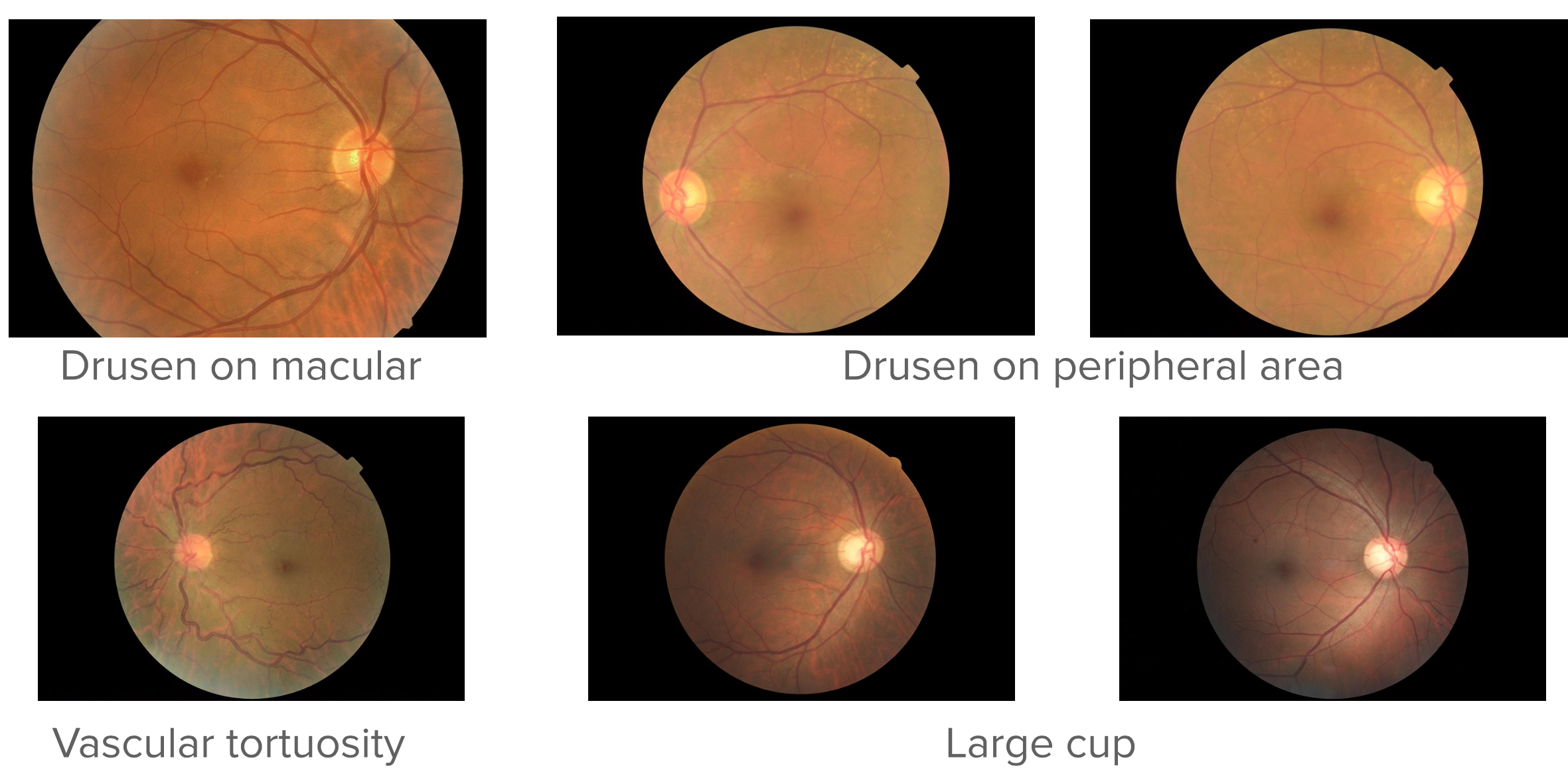 Illustration of the single-label limitation of existing datasets such as EyePACS